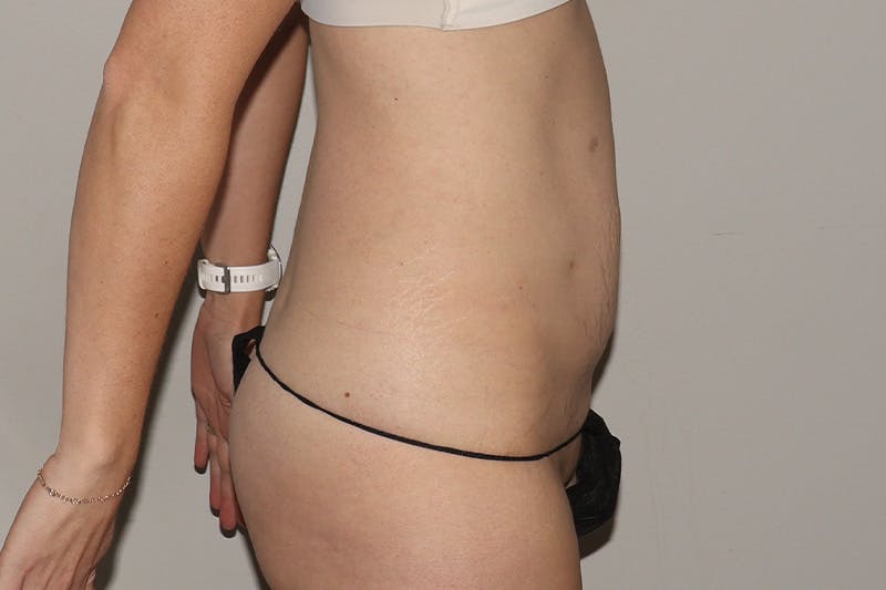 Abdominoplasty Before & After Gallery - Patient 257633 - Image 5