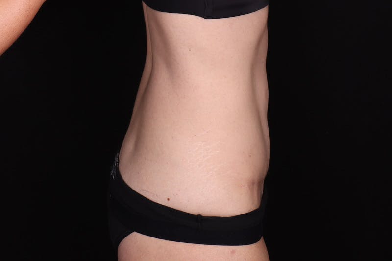 Abdominoplasty Before & After Gallery - Patient 257633 - Image 6