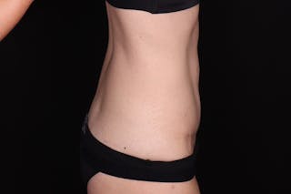 Abdominoplasty Before & After Gallery - Patient 257633 - Image 6