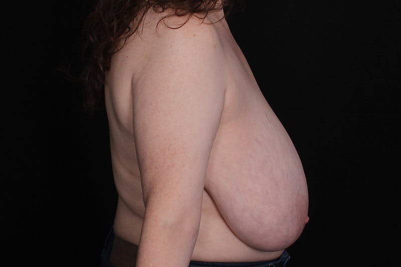 Breast Reduction Before & After Gallery - Patient 373910 - Image 5