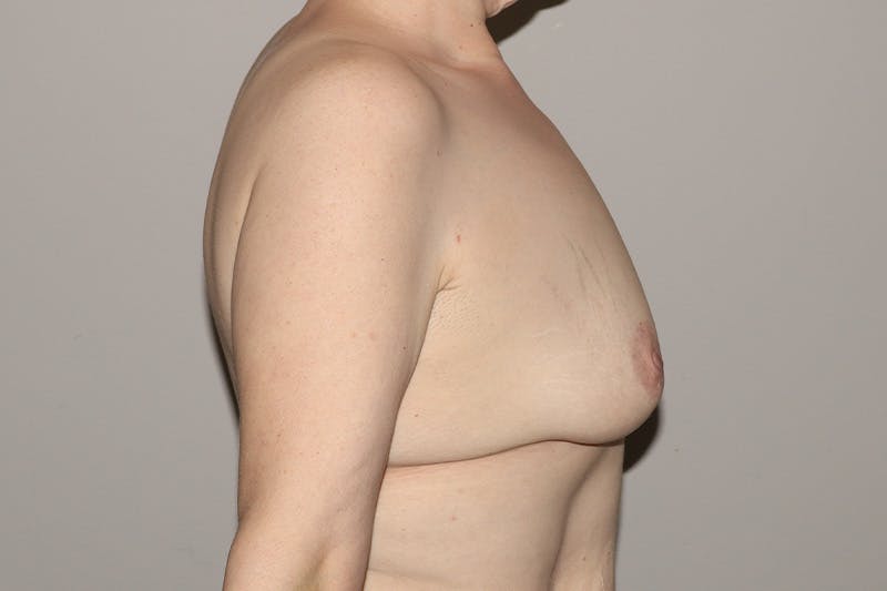 Breast Reconstruction Before & After Gallery - Patient 356169 - Image 5