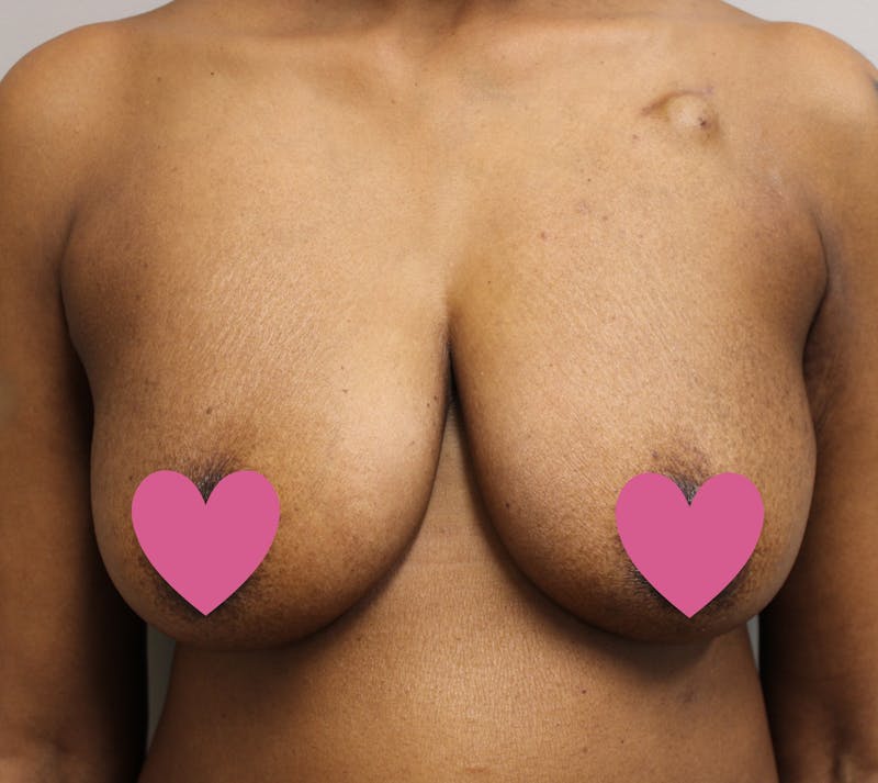 Breast Reconstruction Before & After Gallery - Patient 323879 - Image 1