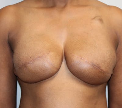 Breast Reconstruction Before & After Gallery - Patient 323879 - Image 2
