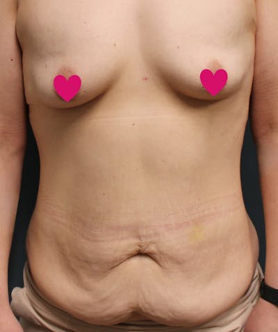 Mommy Makeover Before & After Gallery - Patient 219981 - Image 1