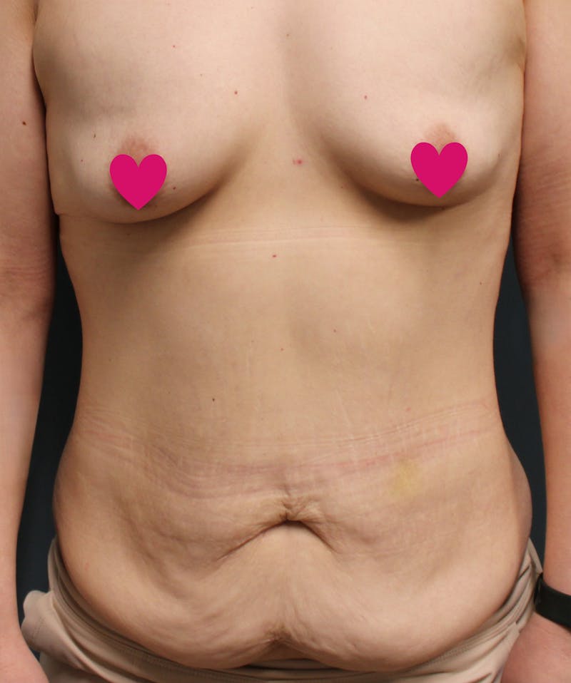Mommy Makeover Before & After Gallery - Patient 219981 - Image 1