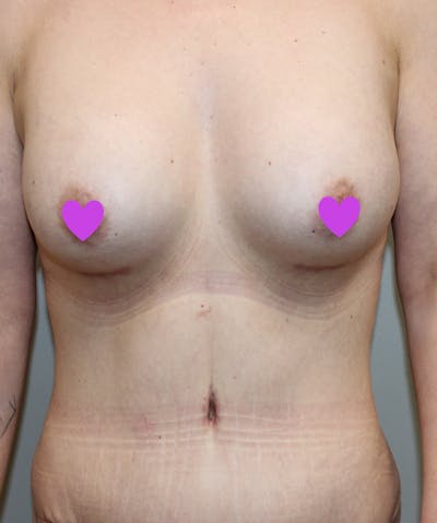 Mommy Makeover Before & After Gallery - Patient 219981 - Image 2