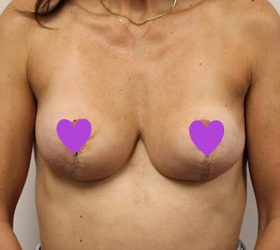 Breast Implant Removal with Lift Before & After Gallery - Patient 119389 - Image 2