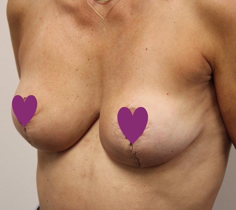 Breast Implant Removal with Lift Before & After Gallery - Patient 119389 - Image 4