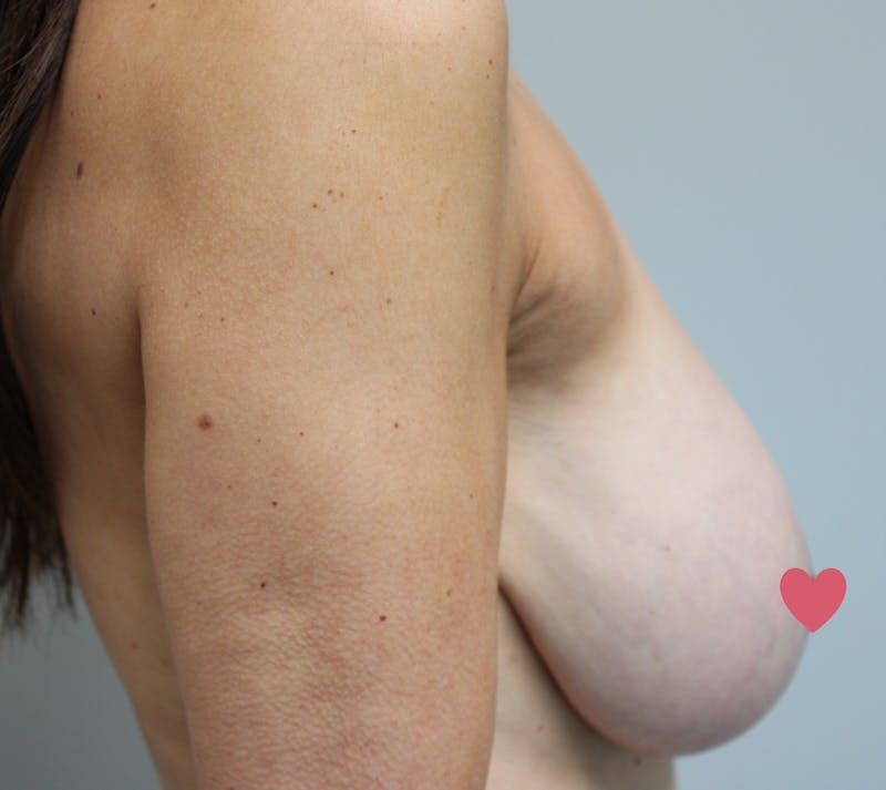 Breast Implant Removal with Lift Before & After Gallery - Patient 119389 - Image 5