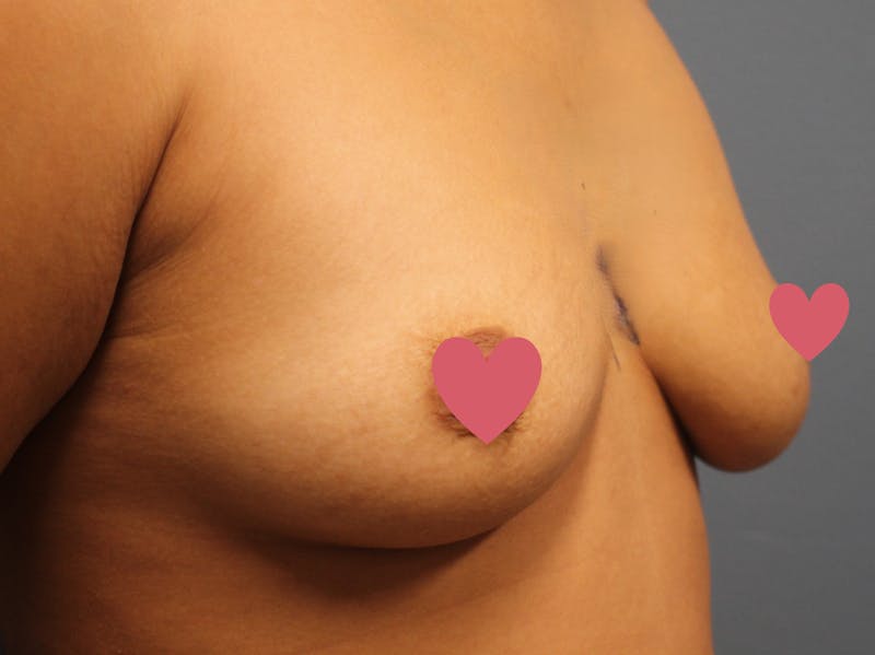 Breast Augmentation Before & After Gallery - Patient 335619 - Image 3