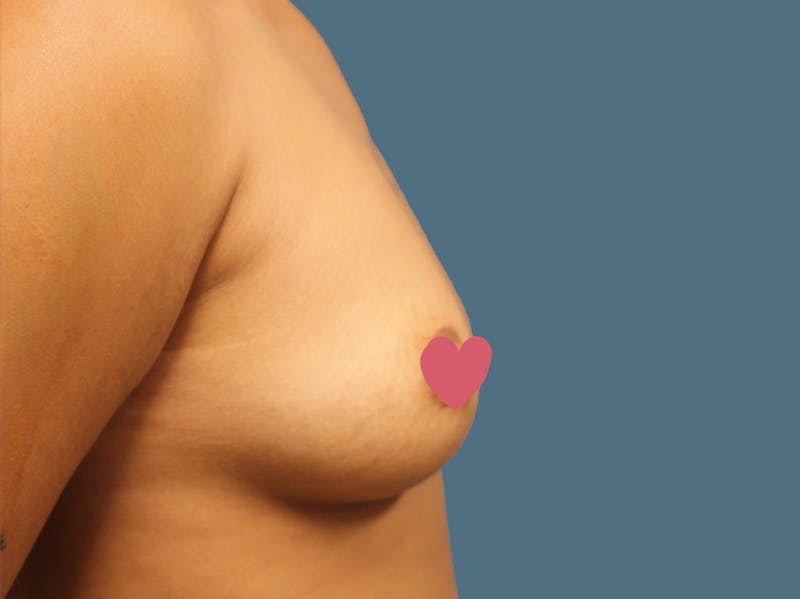 Breast Augmentation Before & After Gallery - Patient 335619 - Image 5