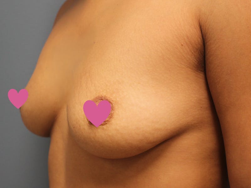 Breast Augmentation Before & After Gallery - Patient 335619 - Image 7