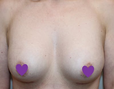 Breast Augmentation Before & After Gallery - Patient 797808 - Image 2