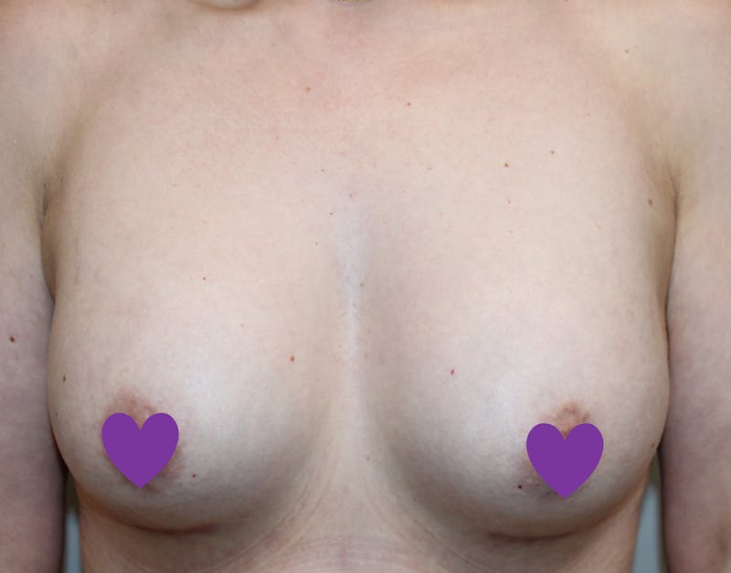 Breast Augmentation Before & After Gallery - Patient 797808 - Image 2