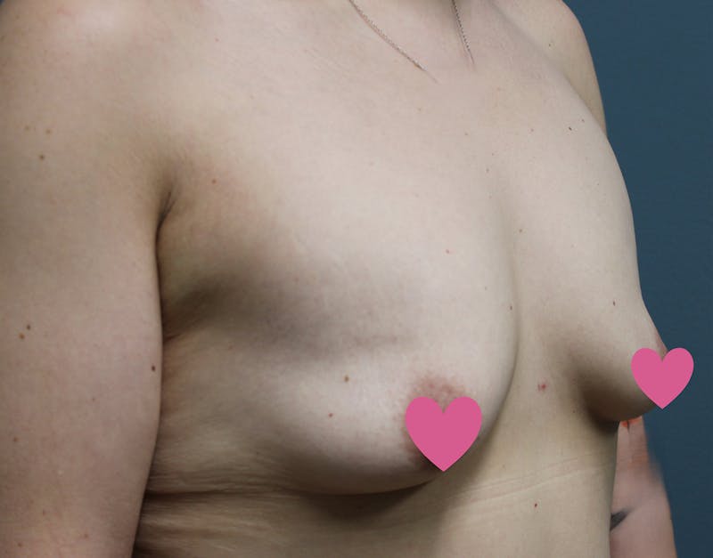 Breast Augmentation Before & After Gallery - Patient 797808 - Image 3