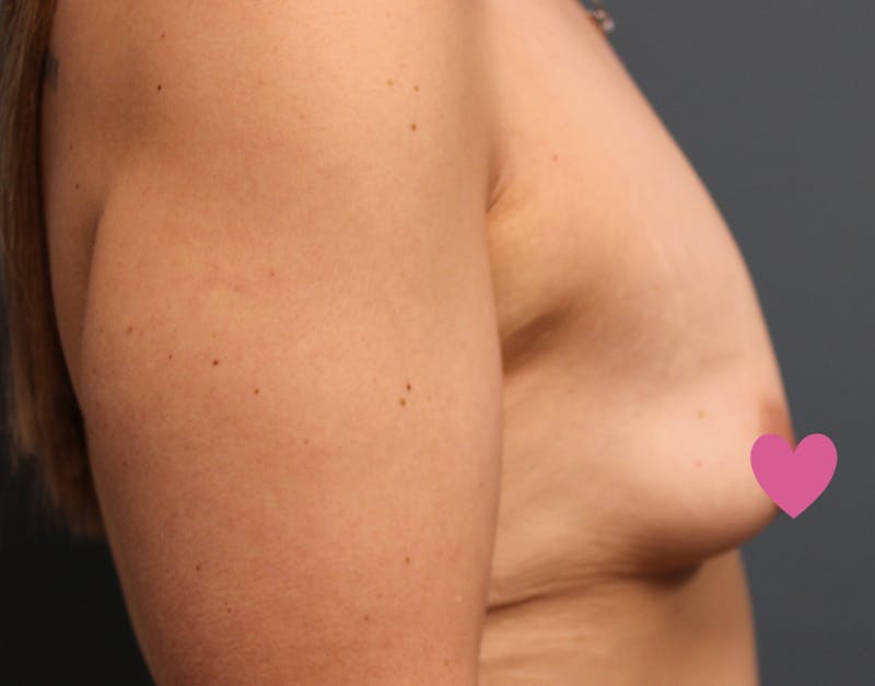 Breast Augmentation Before & After Gallery - Patient 797808 - Image 5