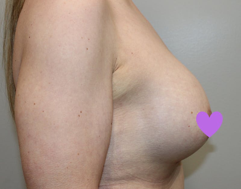 Breast Augmentation Before & After Gallery - Patient 797808 - Image 6