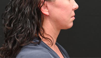 Neck Contouring Before & After Gallery - Patient 111496 - Image 2