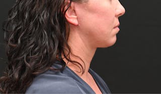 Neck Contouring Before & After Gallery - Patient 111496 - Image 2