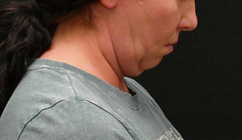 Neck Contouring Before & After Gallery - Patient 111496 - Image 3