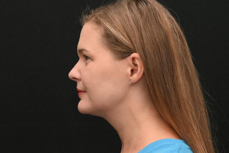 Neck Contouring Before & After Gallery - Patient 326750 - Image 10
