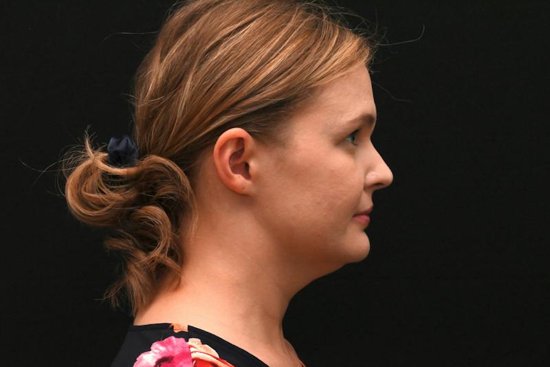 Neck Contouring Before & After Gallery - Patient 326750 - Image 3