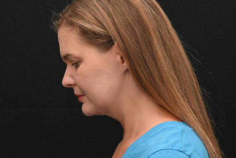 Neck Contouring Before & After Gallery - Patient 326750 - Image 12