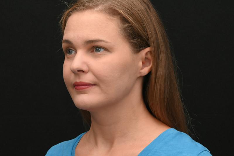Neck Contouring Before & After Gallery - Patient 326750 - Image 8