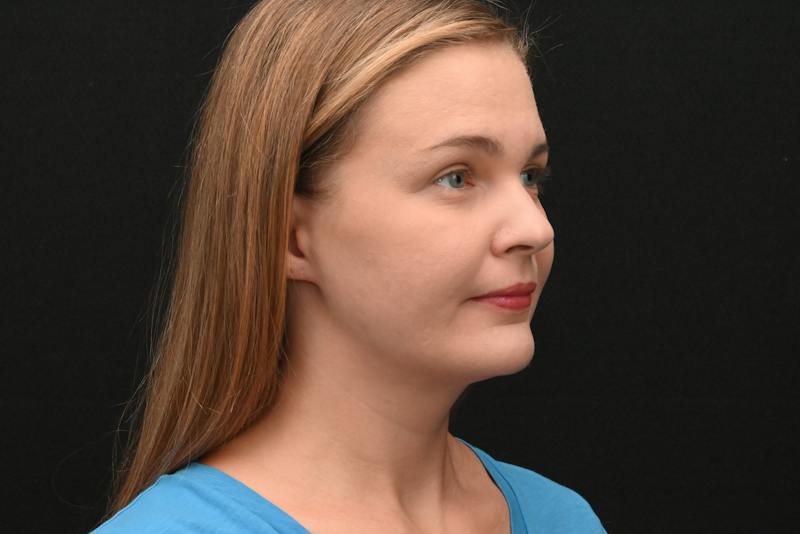 Neck Contouring Before & After Gallery - Patient 326750 - Image 6