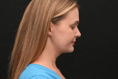 Neck Contouring Before & After Gallery - Patient 326750 - Image 2