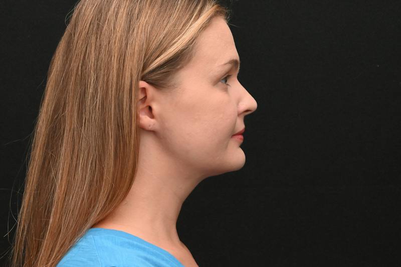 Neck Contouring Before & After Gallery - Patient 326750 - Image 4