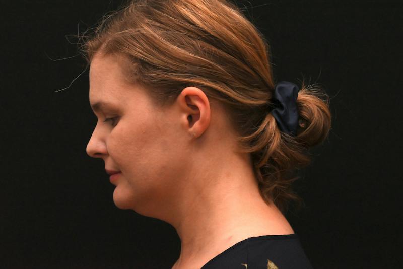 Neck Contouring Before & After Gallery - Patient 326750 - Image 11