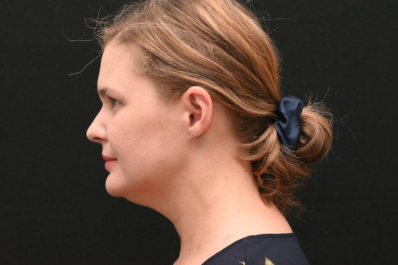 Neck Contouring Before & After Gallery - Patient 326750 - Image 9