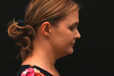 Neck Contouring Before & After Gallery - Patient 326750 - Image 1