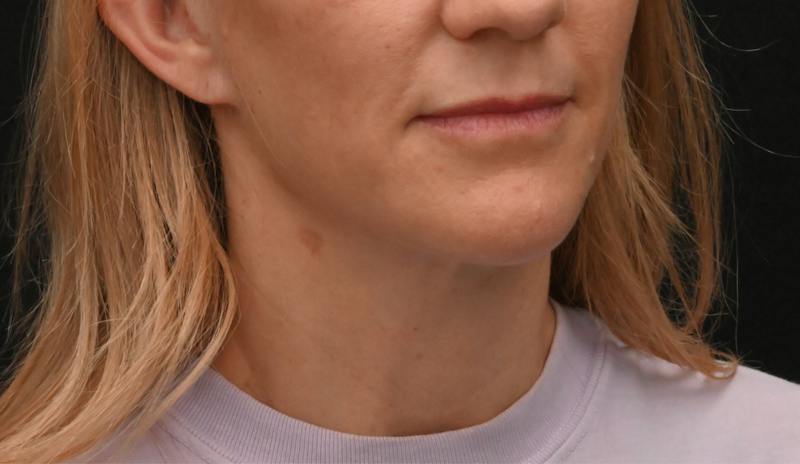 Neck Contouring Before & After Gallery - Patient 422718 - Image 6