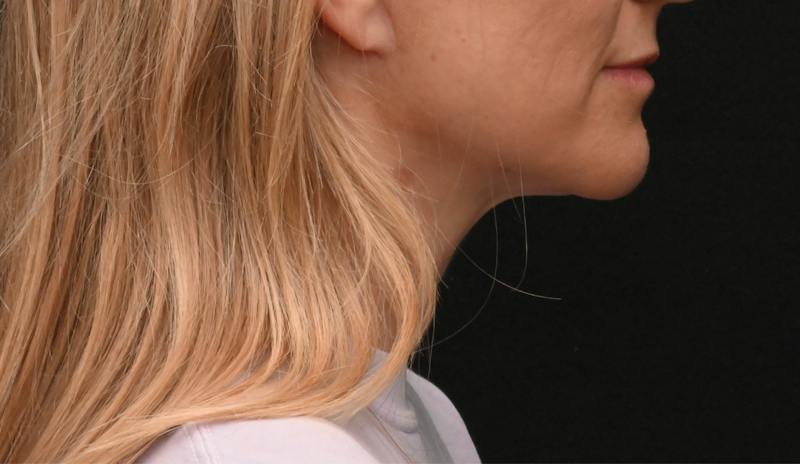 Neck Contouring Before & After Gallery - Patient 422718 - Image 4