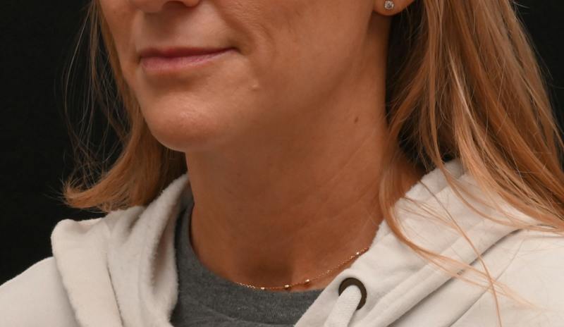 Neck Contouring Before & After Gallery - Patient 422718 - Image 7