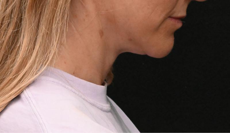 Neck Contouring Before & After Gallery - Patient 422718 - Image 2