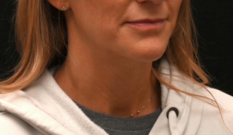 Neck Contouring Before & After Gallery - Patient 422718 - Image 5