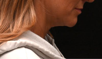 Neck Contouring Before & After Gallery - Patient 422718 - Image 1