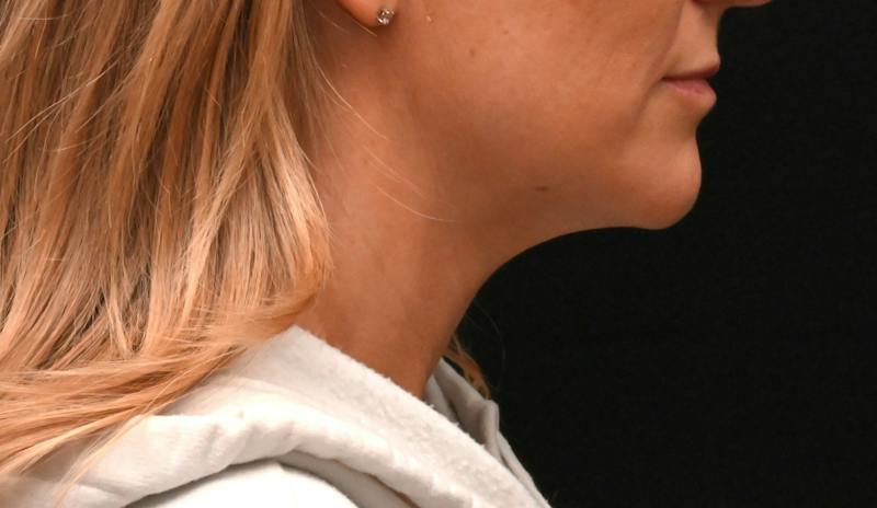 Neck Contouring Before & After Gallery - Patient 422718 - Image 3