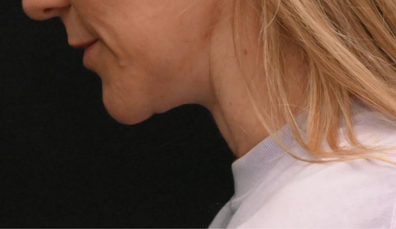 Neck Contouring Before & After Gallery - Patient 422718 - Image 10