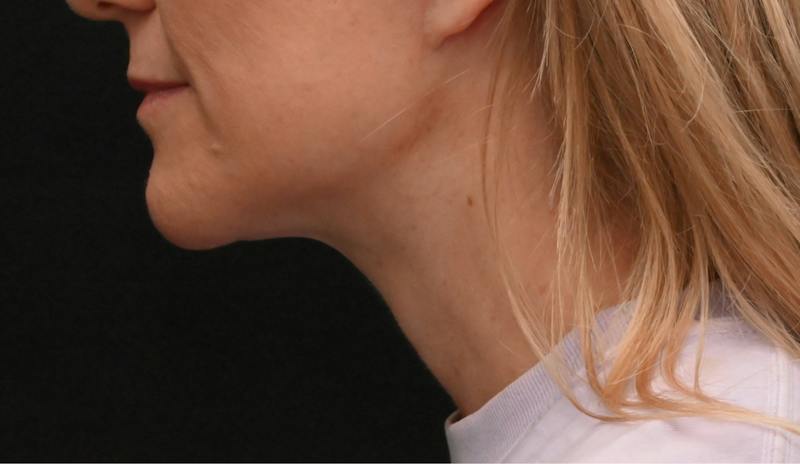 Neck Contouring Before & After Gallery - Patient 422718 - Image 12