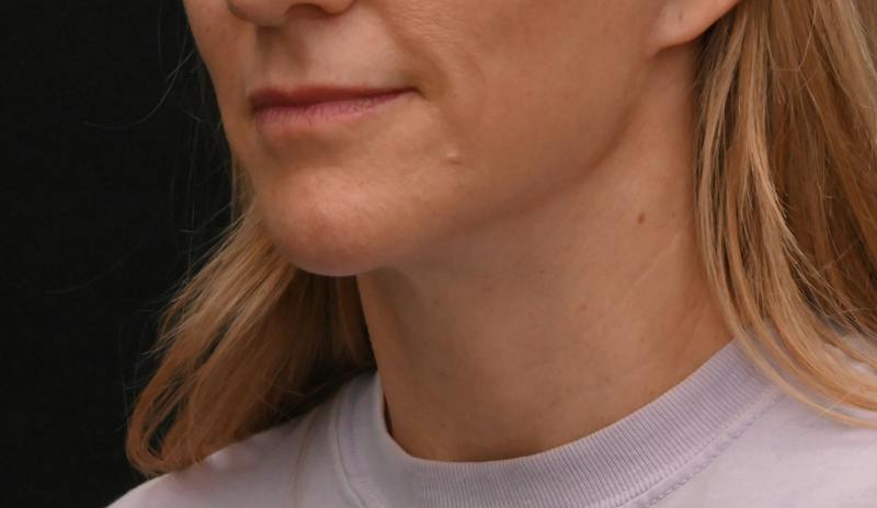 Neck Contouring Before & After Gallery - Patient 422718 - Image 8