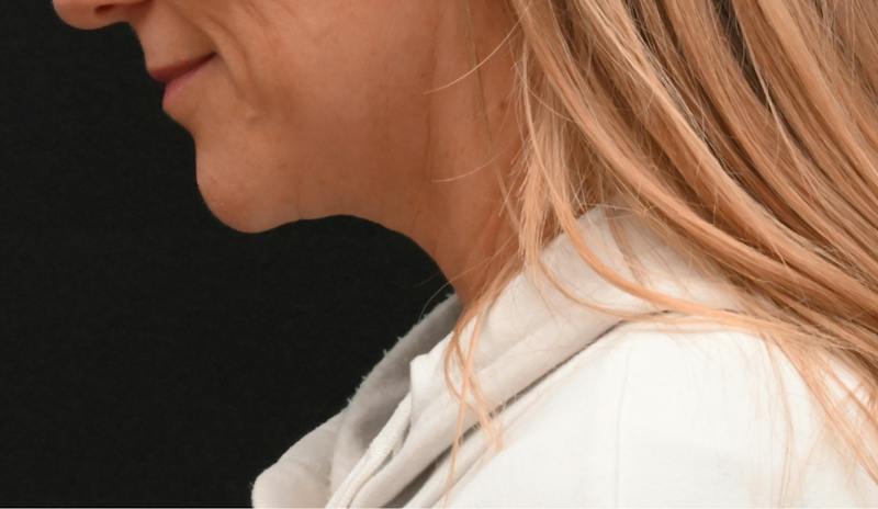 Neck Contouring Before & After Gallery - Patient 422718 - Image 9