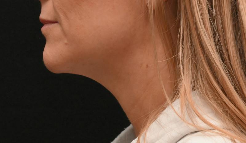 Neck Contouring Before & After Gallery - Patient 422718 - Image 11