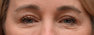 Brow Lift Before & After Gallery - Patient 166812 - Image 2