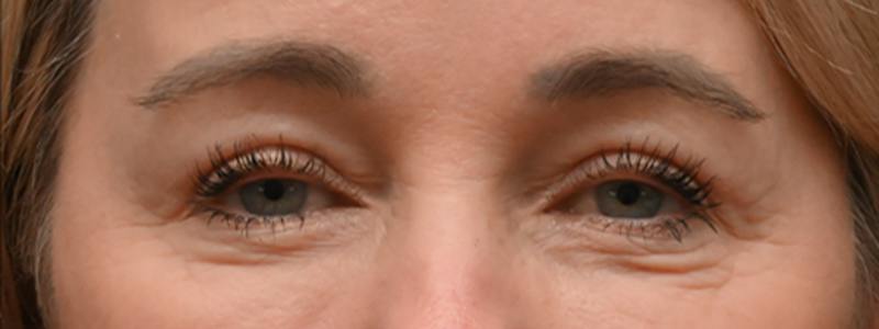 Brow Lift Before & After Gallery - Patient 166812 - Image 2
