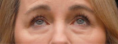 Lower Blepharoplasty Before & After Gallery - Patient 772168 - Image 1