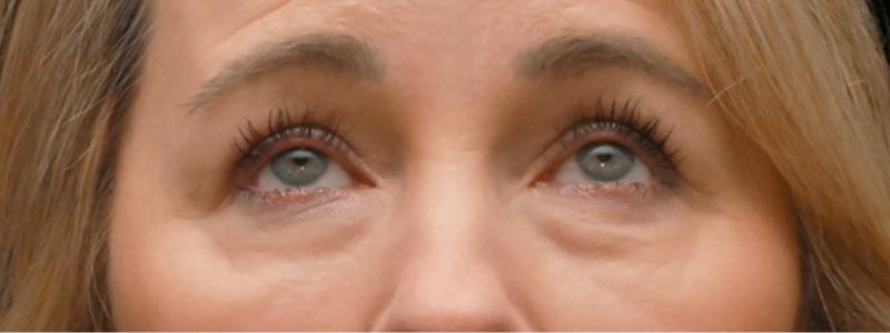 Brow Lift Before & After Gallery - Patient 166812 - Image 3